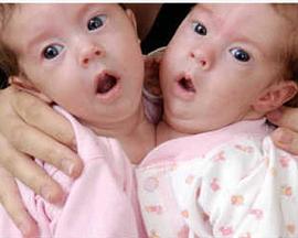 异于常人：连体人封面图